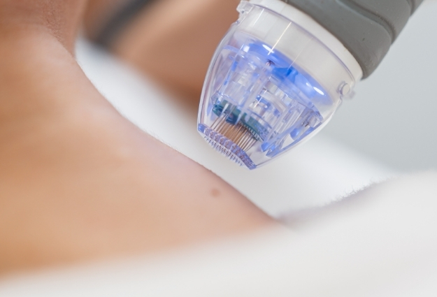 Radiofrekwencja mikroigłowa w Multi Kosmetyka Siedlce — zabieg anti-aging na twarz